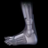 prosthetic foot - the six million dollar man